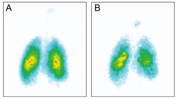 Fig.2 Ventilation and drug deposition scans.