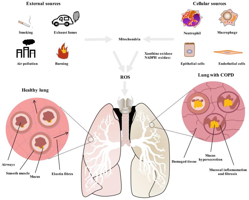 Fig. 1 Differences between a healthy lung and a lung with COPD.