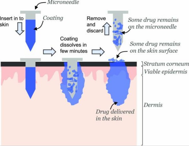 Fig.1 Diagram illustrating how coated microneedles deliver drugs into the skin.