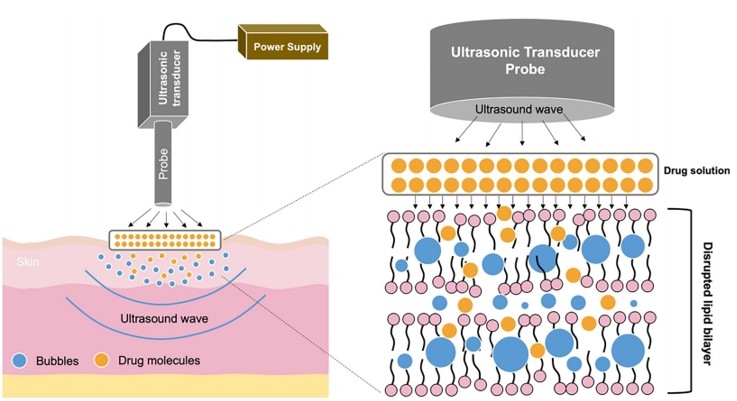 Fig.2 A schematic illustration of sonophoresis-assisted transdermal drug delivery.