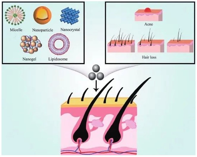Fig.1 Schematic diagram of the hair follicle-targeted drug delivery system for the treatment of acne and hair loss.